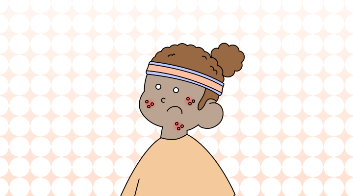 수두(천연두) 영어로 (Chickenpox 및 예시 문장)