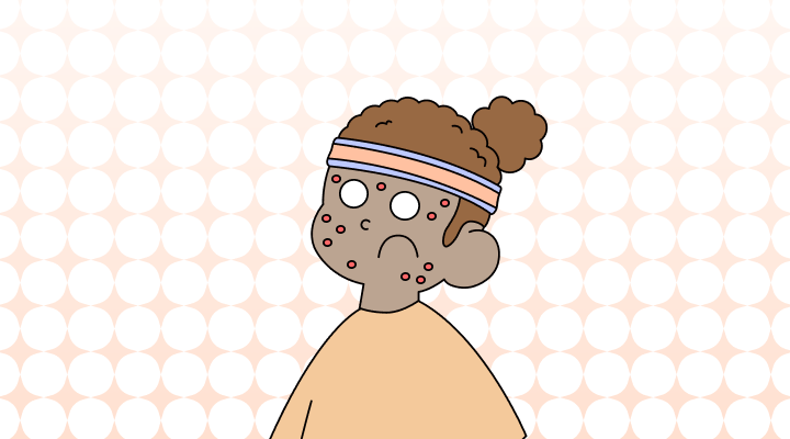 대상포진 영어 (shingles, herpes zoster, chickenpox 차이, 뜻)